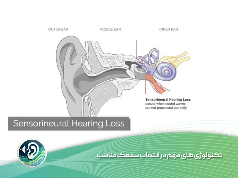 تکنولوژی های مهم در انتخاب سمعک مناسب