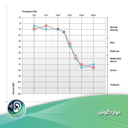 نوار گوش 1 نوار گوش