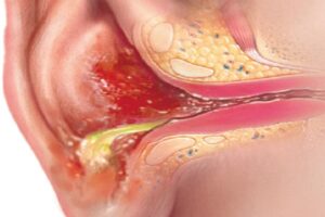 درد شدید گوش یا عفونت گوش میانی؟ تشخیص سریع و بهترین روش‌های درمان