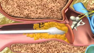 تمیز کردن گوش : راهنمای جامع برای حفظ سلامت کانال شنوایی 3 خطرناک ترین روش تمیز کردن گوش