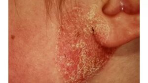 خارش گوش از چی می‌تونه باشه؟ (اگزما)